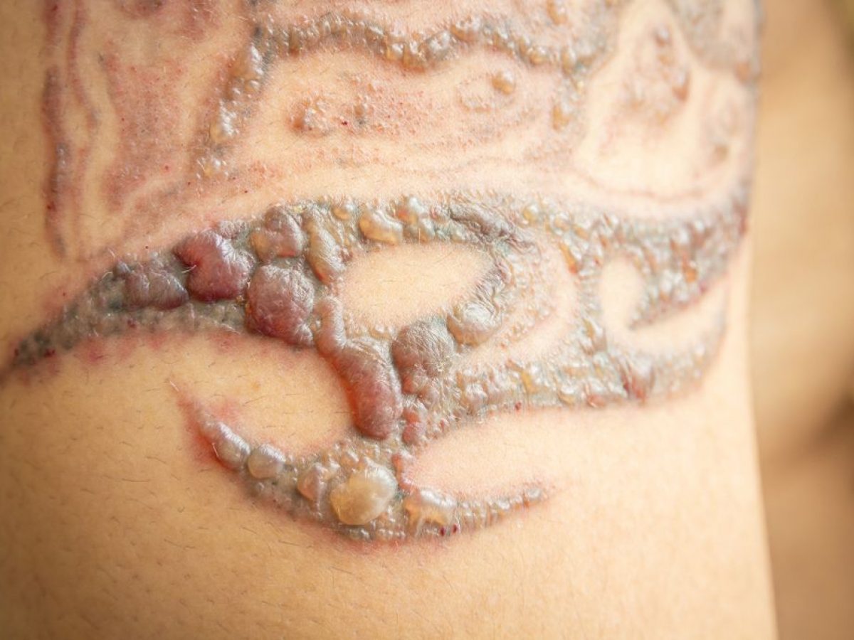 Understanding the Aftercare for Laser Tattoo Removal